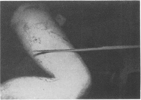 punji stick wounds.